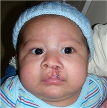 Cleft Lip and Palate Repair Before Photo by Rachel Ruotolo, MD; Garden City, NY - Case 34812