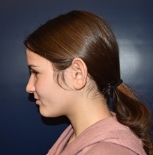 Ear Surgery Before Photo by Rachel Ruotolo, MD; Garden City, NY - Case 34813