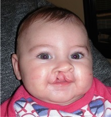 Cleft Lip and Palate Repair Before Photo by Rachel Ruotolo, MD; Garden City, NY - Case 35081