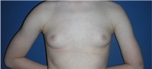 Male Breast Reduction Before Photo by Rachel Ruotolo, MD; Garden City, NY - Case 35527