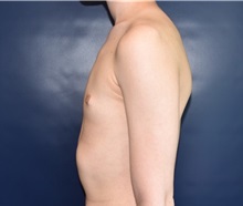 Male Breast Reduction After Photo by Rachel Ruotolo, MD; Garden City, NY - Case 35527