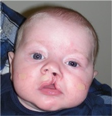 Cleft Lip and Palate Repair Before Photo by Rachel Ruotolo, MD; Garden City, NY - Case 35530