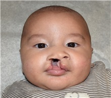 Cleft Lip and Palate Repair Before Photo by Rachel Ruotolo, MD; Garden City, NY - Case 35544