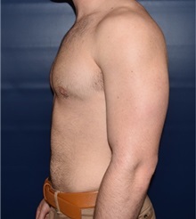 Male Breast Reduction After Photo by Rachel Ruotolo, MD; Garden City, NY - Case 35578