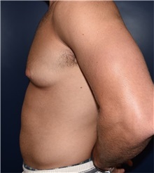 Male Breast Reduction Before Photo by Rachel Ruotolo, MD; Garden City, NY - Case 35578