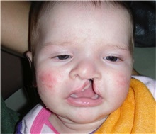 Cleft Lip and Palate Repair Before Photo by Rachel Ruotolo, MD; Garden City, NY - Case 35586