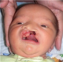 Cleft Lip and Palate Repair Before Photo by Rachel Ruotolo, MD; Garden City, NY - Case 35587