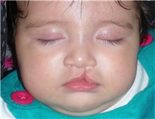 Cleft Lip and Palate Repair Before Photo by Rachel Ruotolo, MD; Garden City, NY - Case 36042