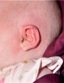 Ear Surgery After Photo by Rachel Ruotolo, MD; Garden City, NY - Case 36061