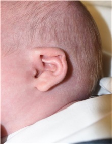 Ear Surgery Before Photo by Rachel Ruotolo, MD; Garden City, NY - Case 36061