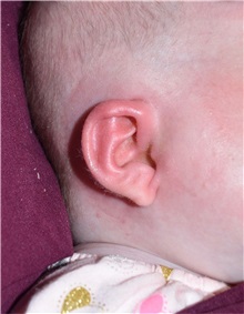 Ear Surgery After Photo by Rachel Ruotolo, MD; Garden City, NY - Case 36061