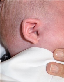 Ear Surgery Before Photo by Rachel Ruotolo, MD; Garden City, NY - Case 36061