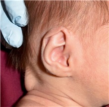 Ear Surgery Before Photo by Rachel Ruotolo, MD; Garden City, NY - Case 36063
