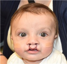 Cleft Lip and Palate Repair Before Photo by Rachel Ruotolo, MD; Garden City, NY - Case 36069