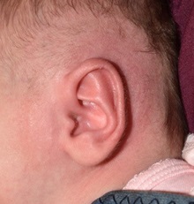 Ear Surgery After Photo by Rachel Ruotolo, MD; Garden City, NY - Case 36162
