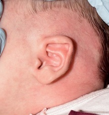 Ear Surgery Before Photo by Rachel Ruotolo, MD; Garden City, NY - Case 36162