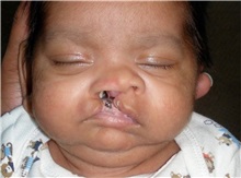 Cleft Lip and Palate Repair Before Photo by Rachel Ruotolo, MD; Garden City, NY - Case 36164