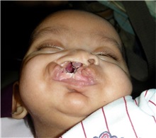Cleft Lip and Palate Repair Before Photo by Rachel Ruotolo, MD; Garden City, NY - Case 36164
