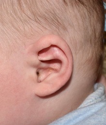 Ear Surgery After Photo by Rachel Ruotolo, MD; Garden City, NY - Case 36167