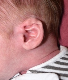 Ear Surgery Before Photo by Rachel Ruotolo, MD; Garden City, NY - Case 36167