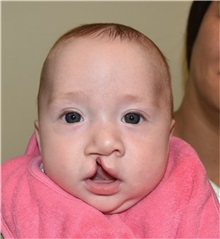 Cleft Lip and Palate Repair Before Photo by Rachel Ruotolo, MD; Garden City, NY - Case 36170