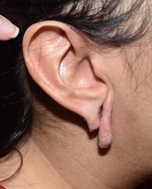 Ear Reconstruction Surgery Before Photo by Rachel Ruotolo, MD; Garden City, NY - Case 36175