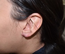 Ear Reconstruction Surgery After Photo by Rachel Ruotolo, MD; Garden City, NY - Case 36175