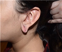 Ear Reconstruction Surgery Before Photo by Rachel Ruotolo, MD; Garden City, NY - Case 36175