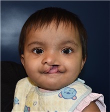 Cleft Lip and Palate Repair Before Photo by Rachel Ruotolo, MD; Garden City, NY - Case 37793