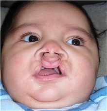 Cleft Lip and Palate Repair Before Photo by Rachel Ruotolo, MD; Garden City, NY - Case 37797