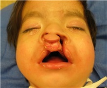 Cleft Lip and Palate Repair Before Photo by Rachel Ruotolo, MD; Garden City, NY - Case 37800