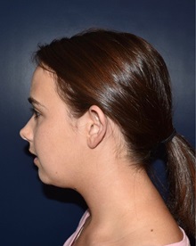 Ear Surgery Before Photo by Rachel Ruotolo, MD; Garden City, NY - Case 37807