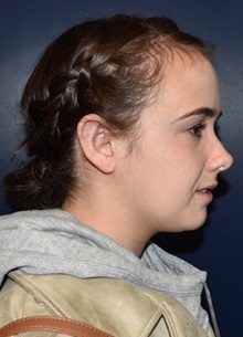 Ear Surgery After Photo by Rachel Ruotolo, MD; Garden City, NY - Case 37807