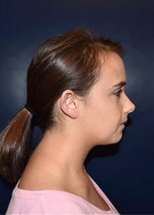 Ear Surgery Before Photo by Rachel Ruotolo, MD; Garden City, NY - Case 37807