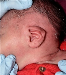 Ear Surgery Before Photo by Rachel Ruotolo, MD; Garden City, NY - Case 37810