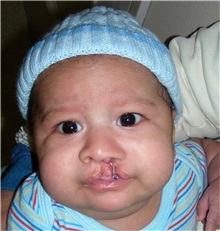 Cleft Lip and Palate Repair Before Photo by Rachel Ruotolo, MD; Garden City, NY - Case 37813