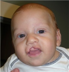 Cleft Lip and Palate Repair Before Photo by Rachel Ruotolo, MD; Garden City, NY - Case 37815