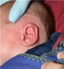 Ear Surgery After Photo by Rachel Ruotolo, MD; Garden City, NY - Case 37816