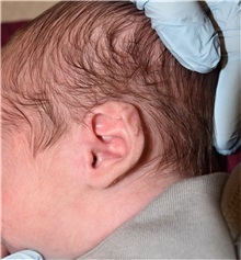 Ear Surgery Before Photo by Rachel Ruotolo, MD; Garden City, NY - Case 37816