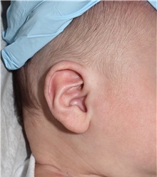 Ear Surgery After Photo by Rachel Ruotolo, MD; Garden City, NY - Case 37821