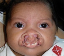Cleft Lip and Palate Repair Before Photo by Rachel Ruotolo, MD; Garden City, NY - Case 38000