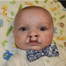 Cleft Lip and Palate Repair Before Photo by Rachel Ruotolo, MD; Garden City, NY - Case 38004