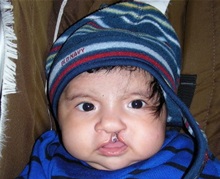 Cleft Lip and Palate Repair Before Photo by Rachel Ruotolo, MD; Garden City, NY - Case 38007