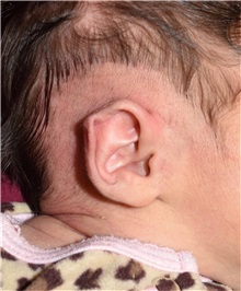 Ear Surgery Before Photo by Rachel Ruotolo, MD; Garden City, NY - Case 38008