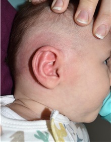 Ear Surgery After Photo by Rachel Ruotolo, MD; Garden City, NY - Case 38032