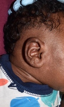 Ear Surgery After Photo by Rachel Ruotolo, MD; Garden City, NY - Case 38038