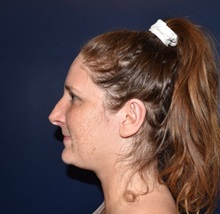 Ear Surgery After Photo by Rachel Ruotolo, MD; Garden City, NY - Case 38101