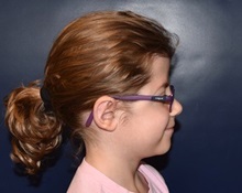 Ear Surgery After Photo by Rachel Ruotolo, MD; Garden City, NY - Case 38102