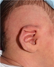Ear Surgery Before Photo by Rachel Ruotolo, MD; Garden City, NY - Case 38114