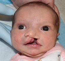Cleft Lip and Palate Repair Before Photo by Rachel Ruotolo, MD; Garden City, NY - Case 38118